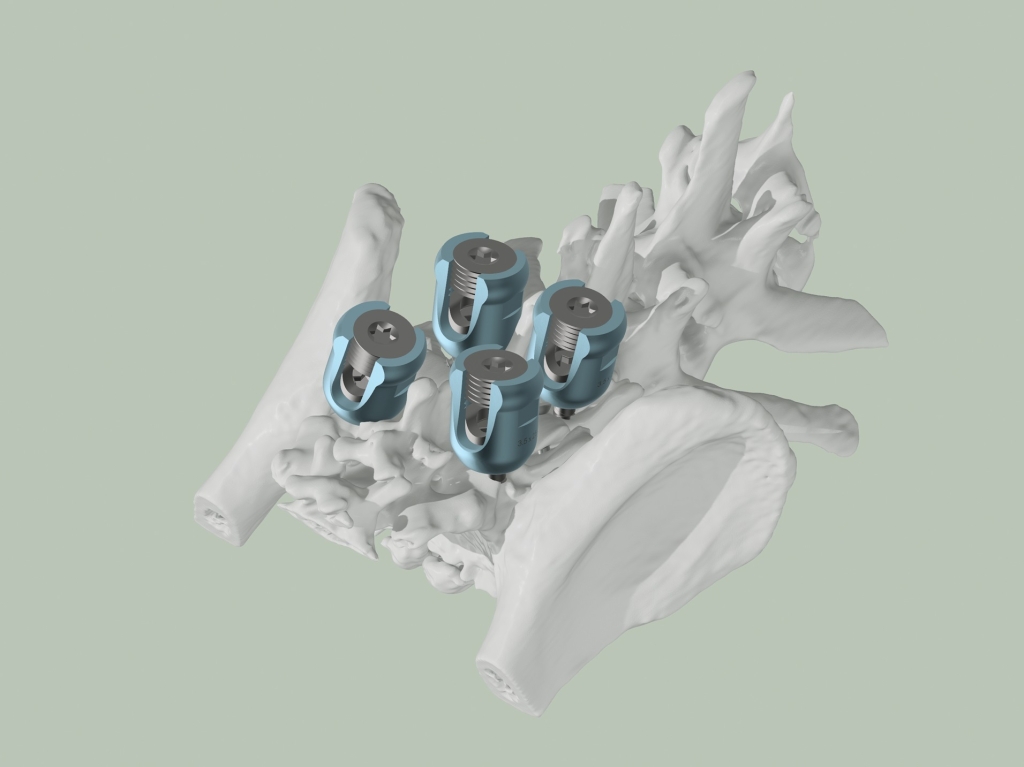 NDSR's Pioneering Spinal Care 'transformational'